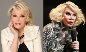 Joan - Before & After Plastic Surgery